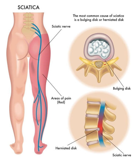 Lumbar Back Brace | Chronic Pain Relief from Sciatica and Pinched Nerve