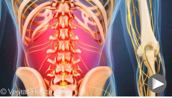 Lumbar Vertebrae w/ Herniated Disc Anatomical Spine NEW 