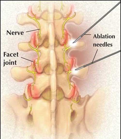 Lumbar Facet Irritation