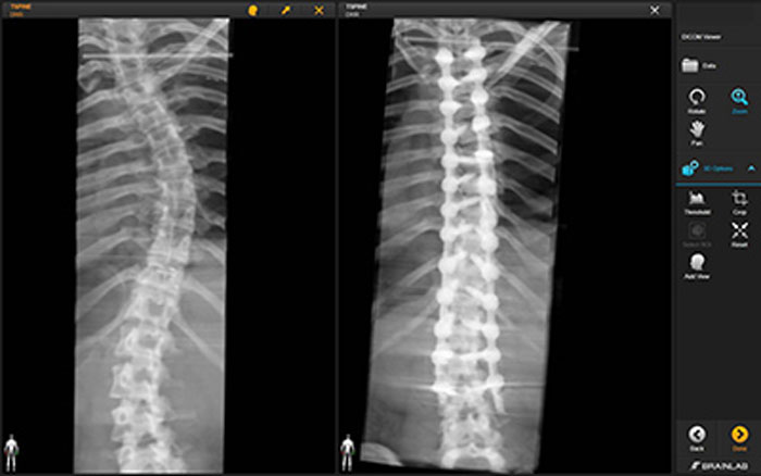 Scoliosis x-ray before and after