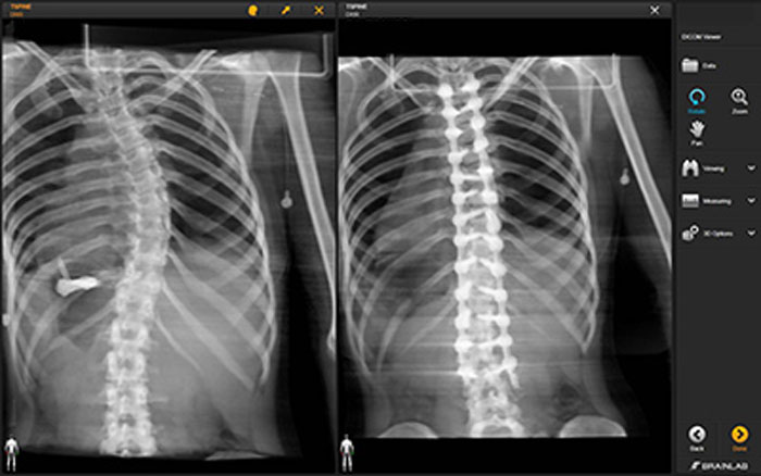 Scoliosis x-ray before and after