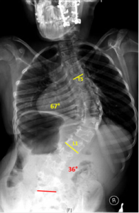 Severe scoliosis is one of the conditions that require advanced skills in complex spine surgery