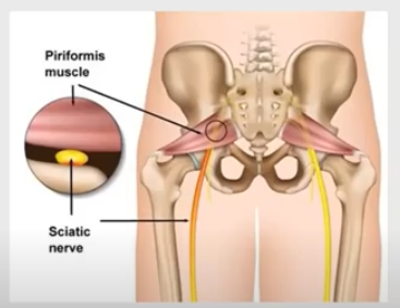 piriformis syndrome